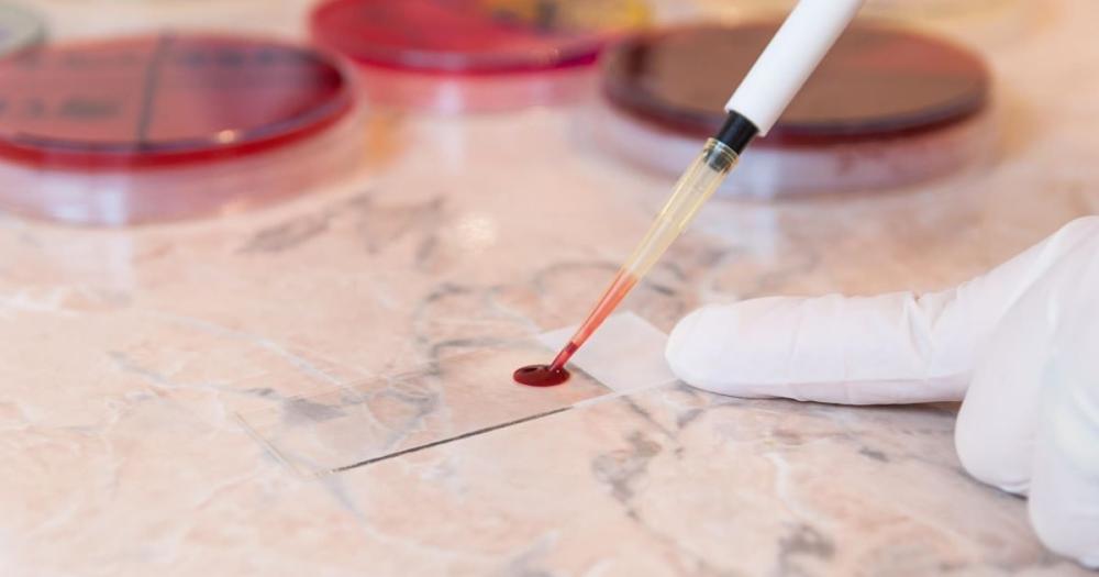 Un análisis rápido de sangre puede mejorar el tratamiento del accidente cerebrovascular